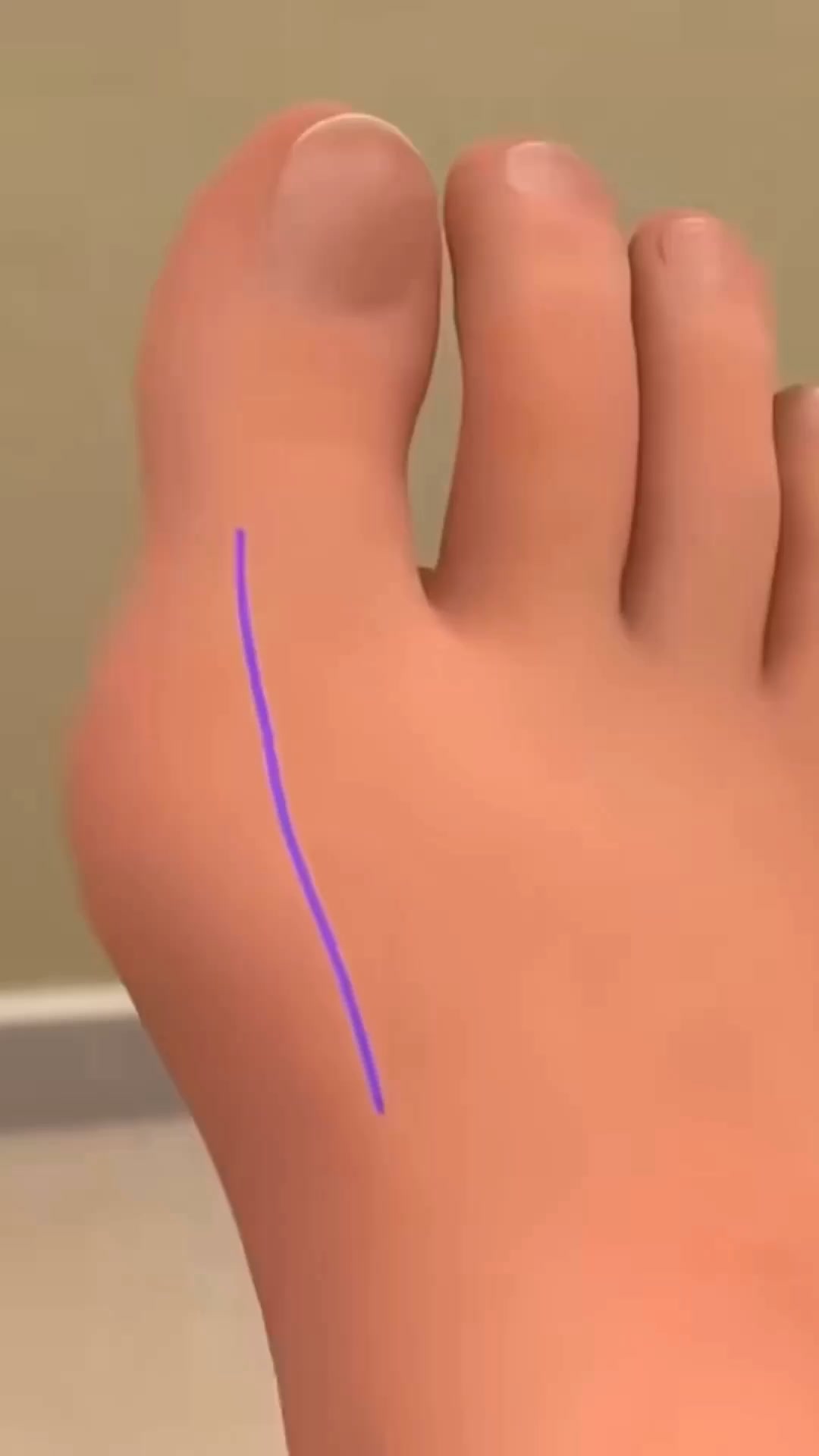 15-Min Bunion Relief With EMS | 50% OFF