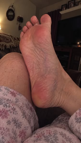 Därför läker inte din plantar fasciit, och vad som faktiskt hjälper
