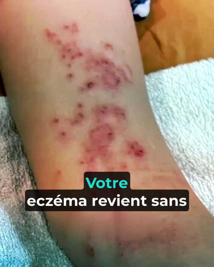 Prenez soin de vos zones sèches et sensibles.