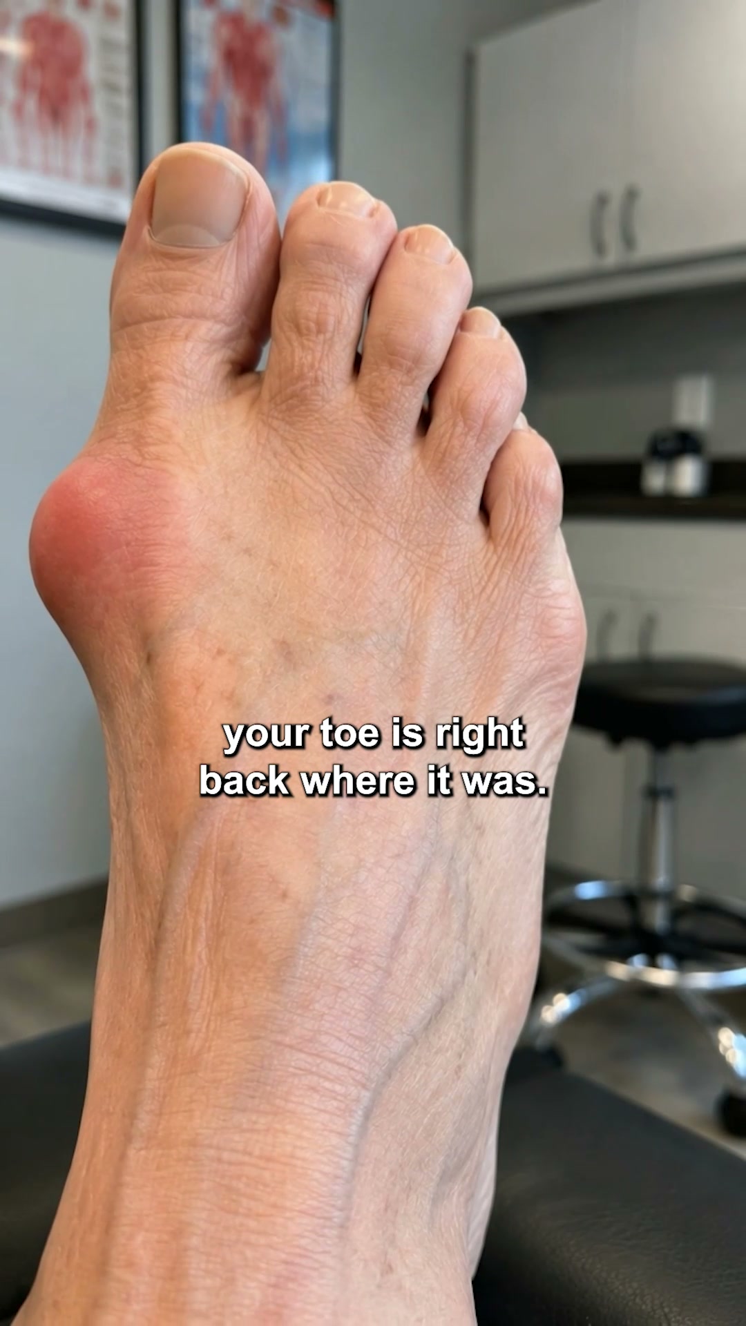If you cut a bunion off, it grows back