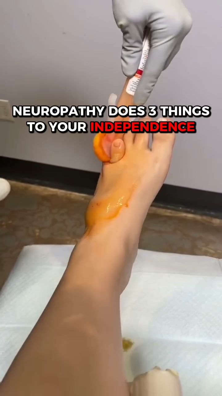 Say Goodbye to Neuropathy Pain