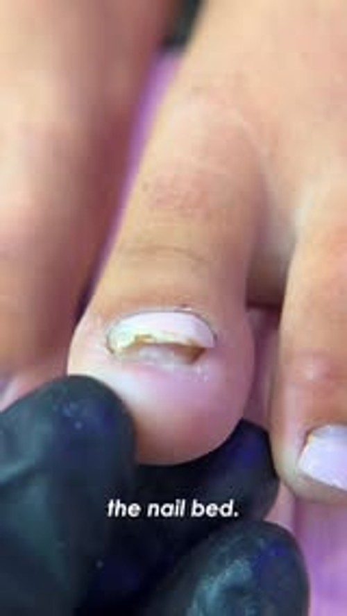 Free Yourself from Fungal Issues!