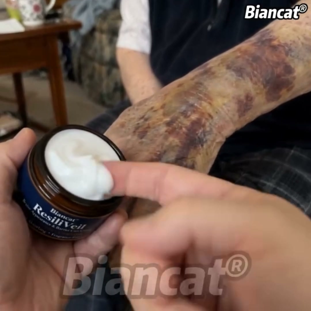 Stubborn Bruises? Try This 5-Minute Remedy
