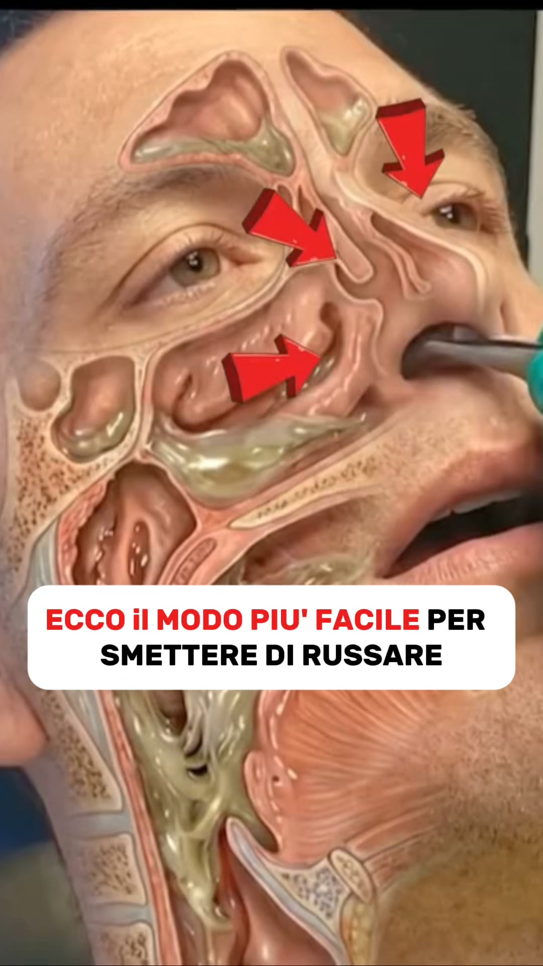 Smetti di russare dalla prima notte