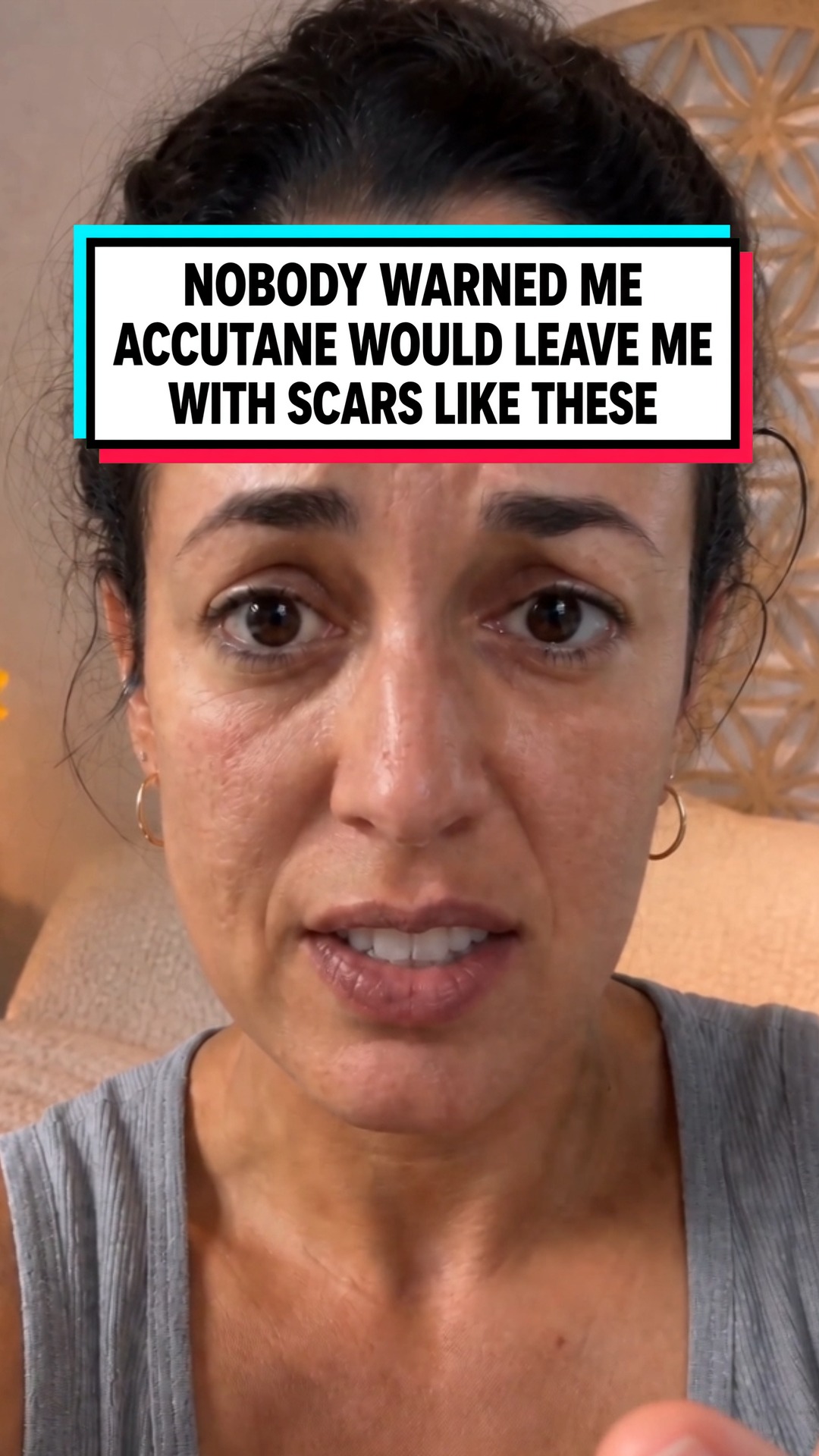 Accutane Cleared My Acne. Not My Scars.
