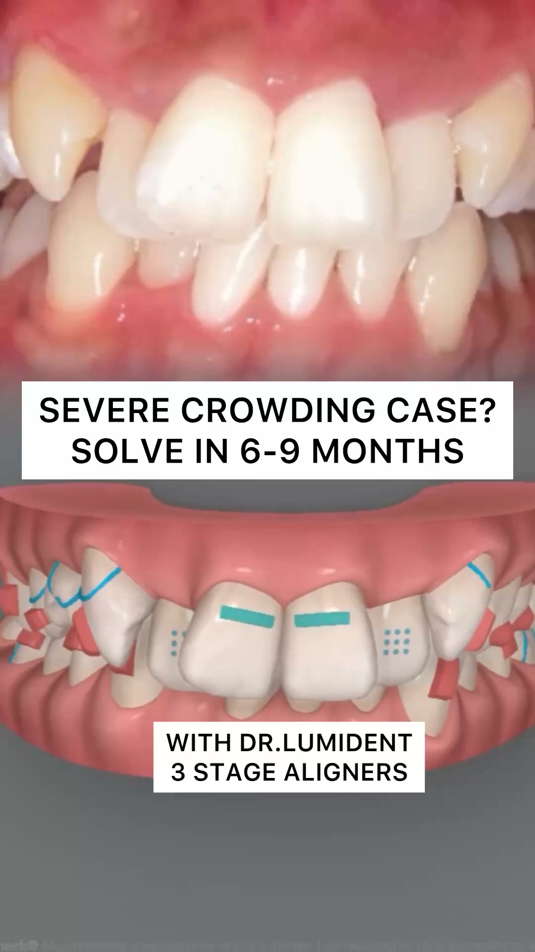 A Smarter Approach to Teeth Alignment