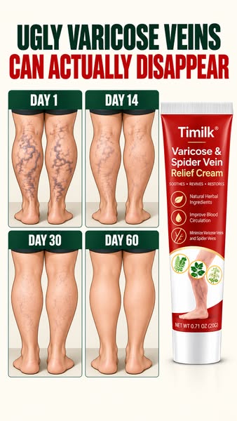 No More Varicose & Spider Veins