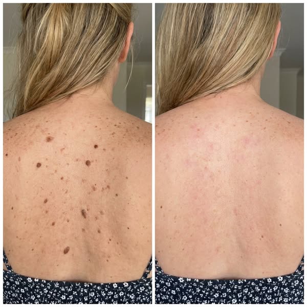Read If Your Skin Barnacles Keep Multiplying