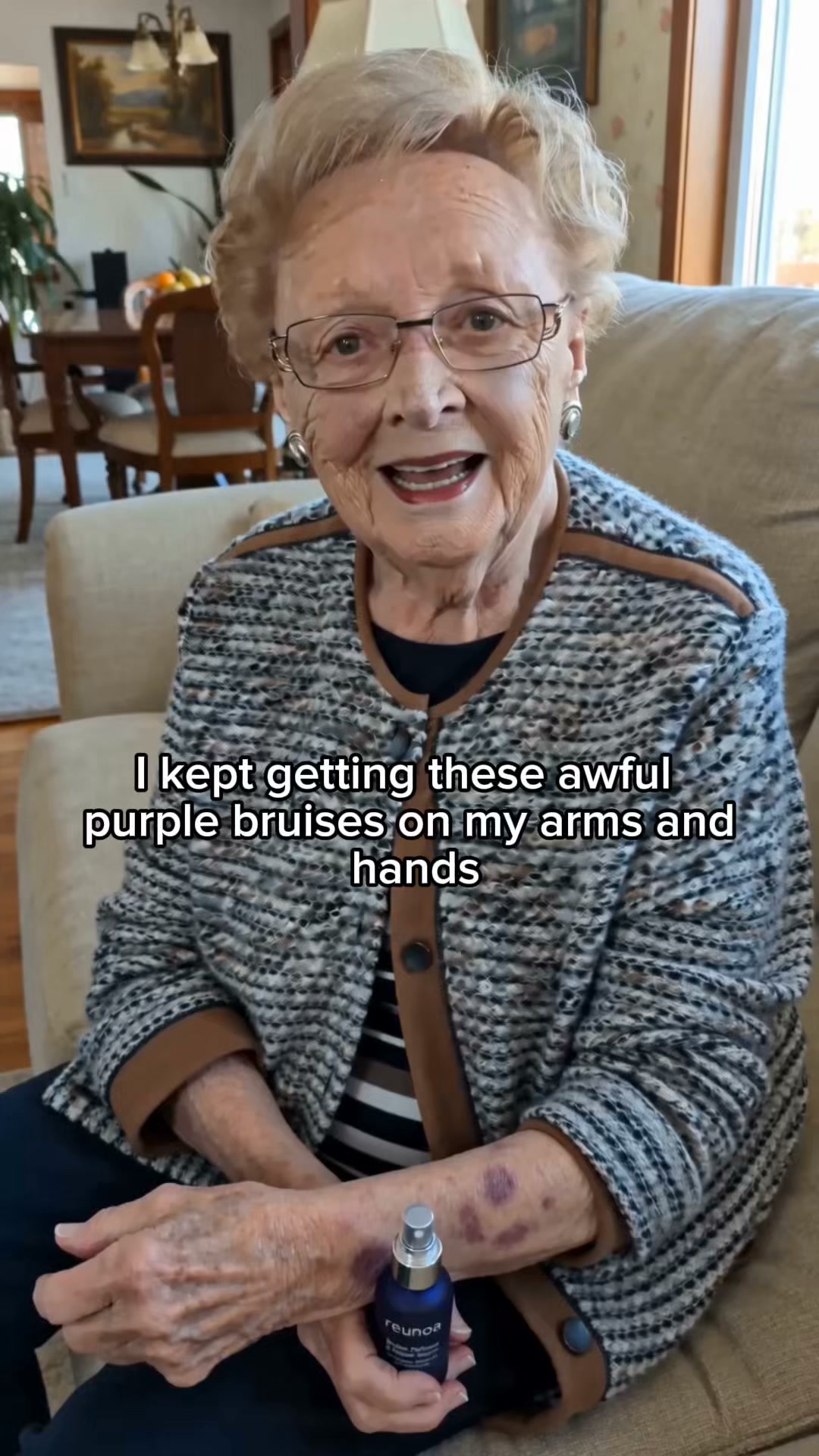 Bruises Gone In Days!