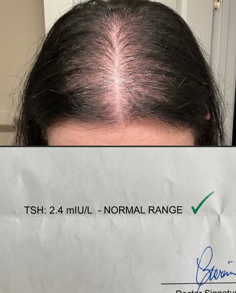 Read this if your TSH is "perfect" but you're going bald