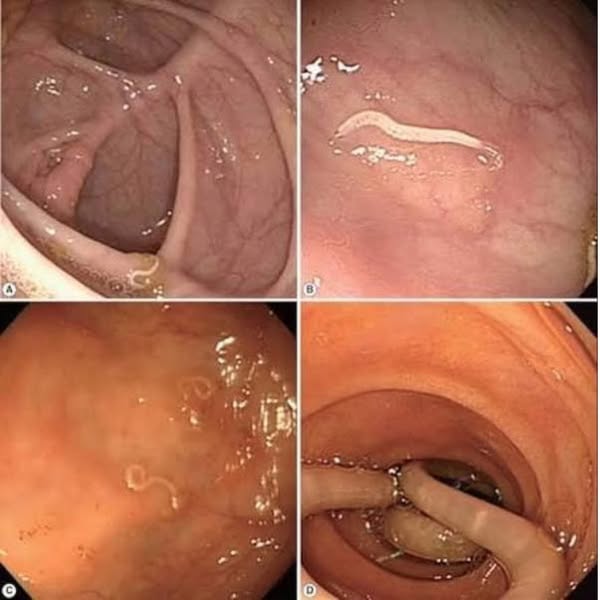 Disintossica il tuo corpo in modo naturale