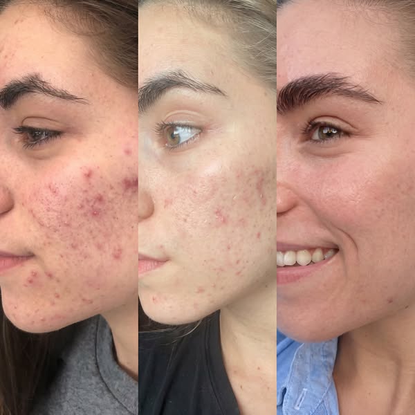 Blackheads That Won't Go Away