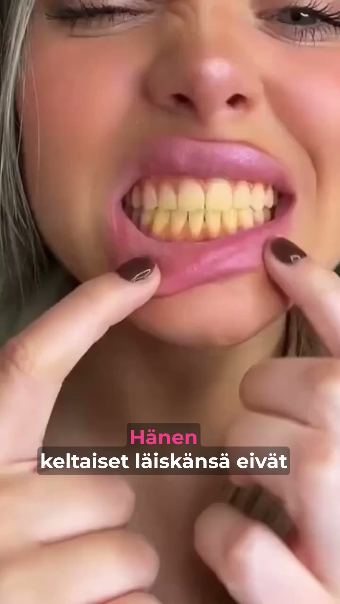 Saat valkoisemmat hampaat jo nyt