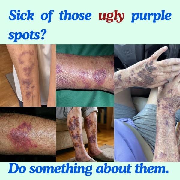Bruises Gone In Days