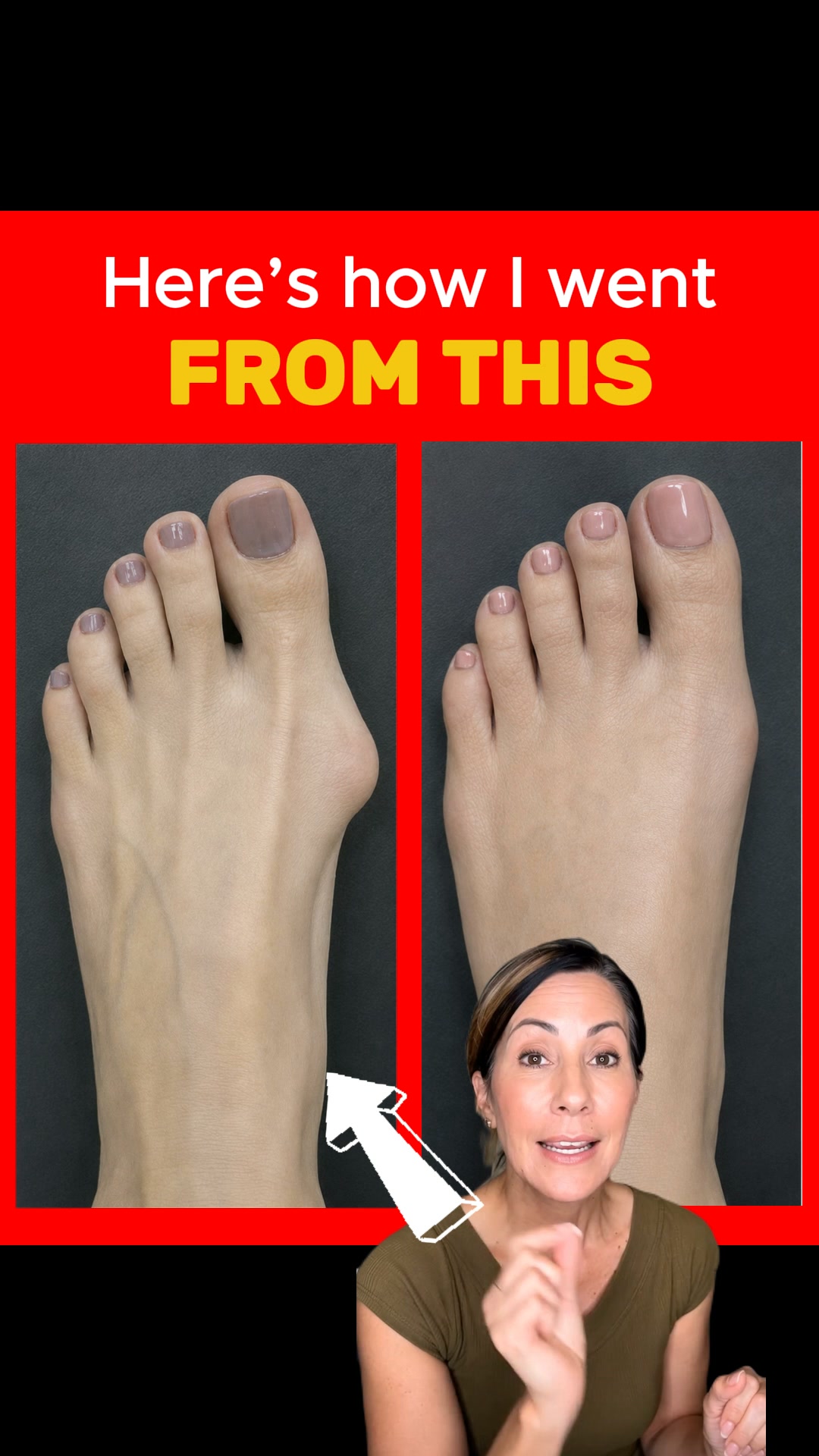 Fix Your Bunions Without Surgery