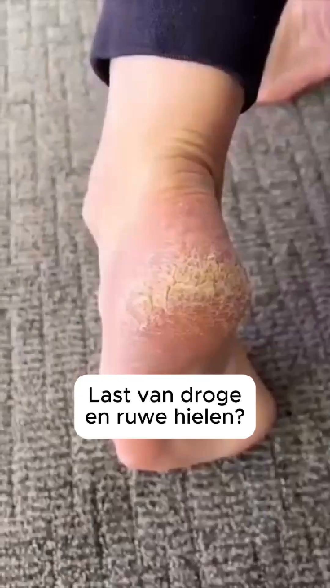 Alles geprobeerd tegen eelt?