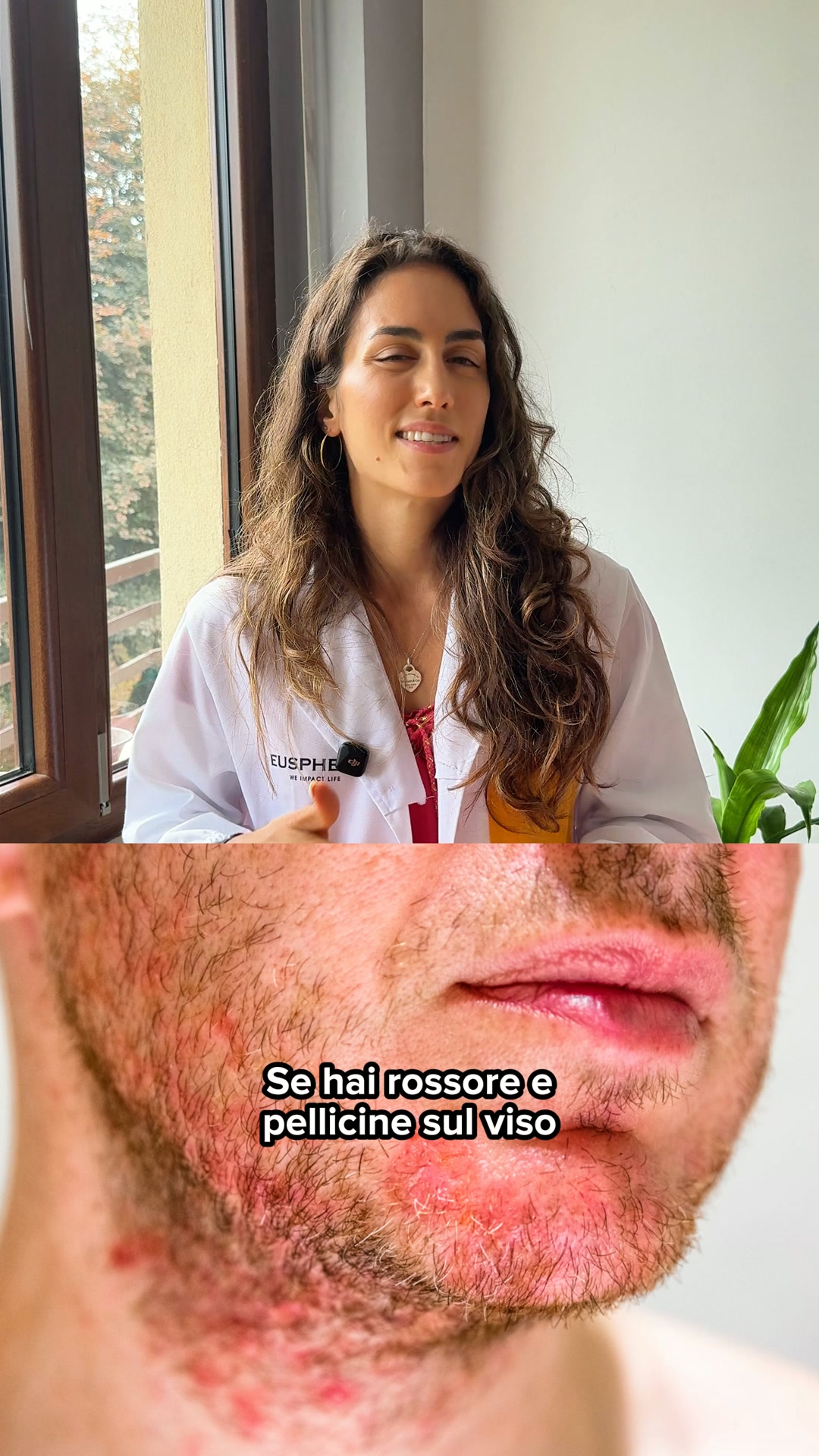 Supporto naturale per la tua Dermatite Seborroica