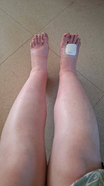YEARS of hiding your legs in 2 days?