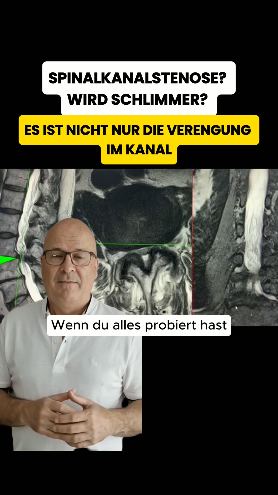 Deswegen wird deine Spinalkanalstenose nie besser