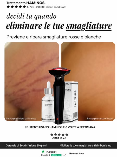 Prenditi cura delle tue smagliature da casa