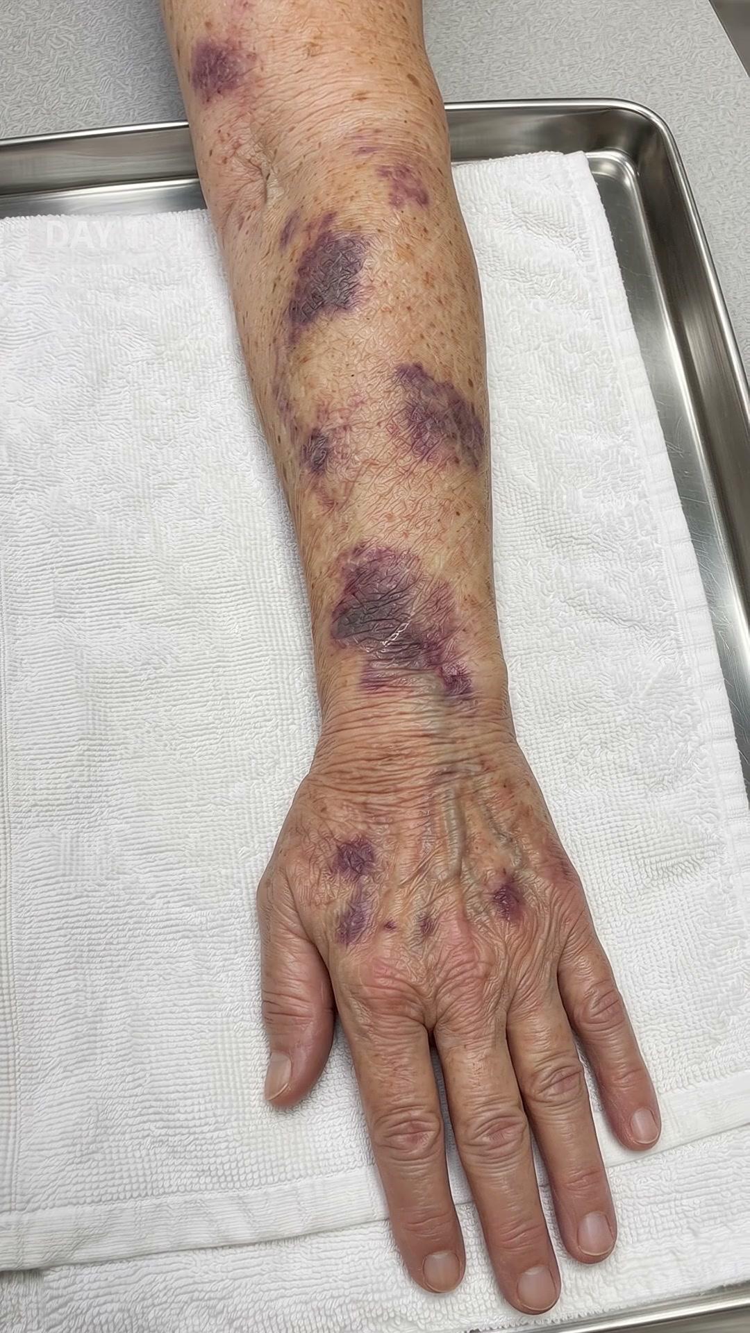 Senile Purpura Gone In Days