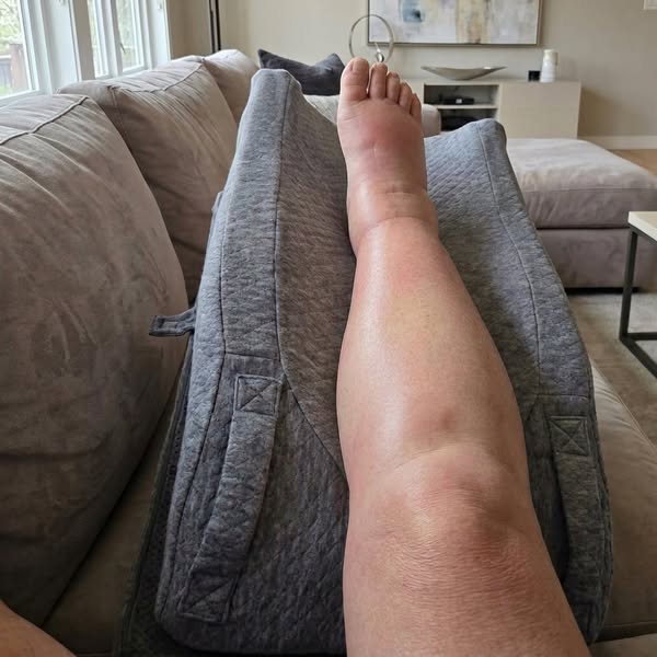 "4 years of my oedema swelling gone in 1 month?"