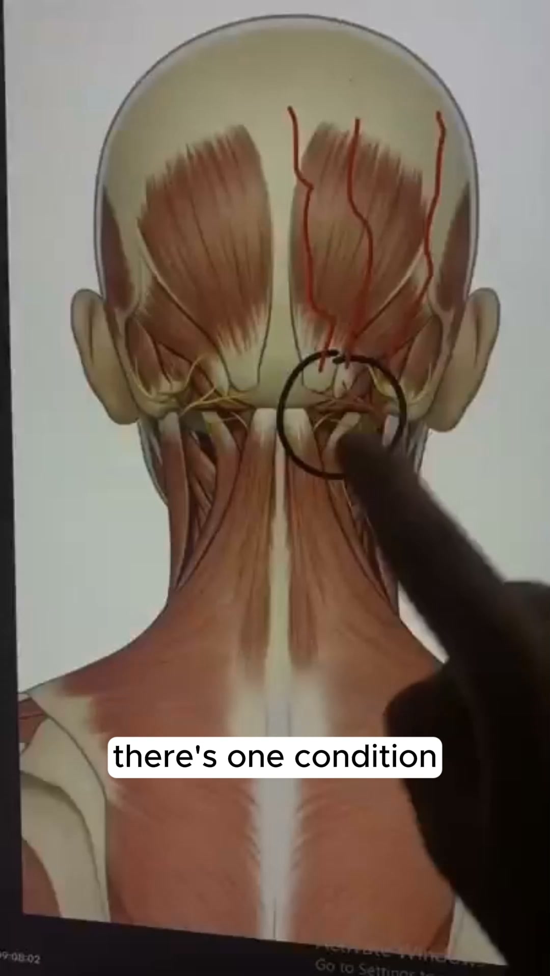 The headache that starts in your neck