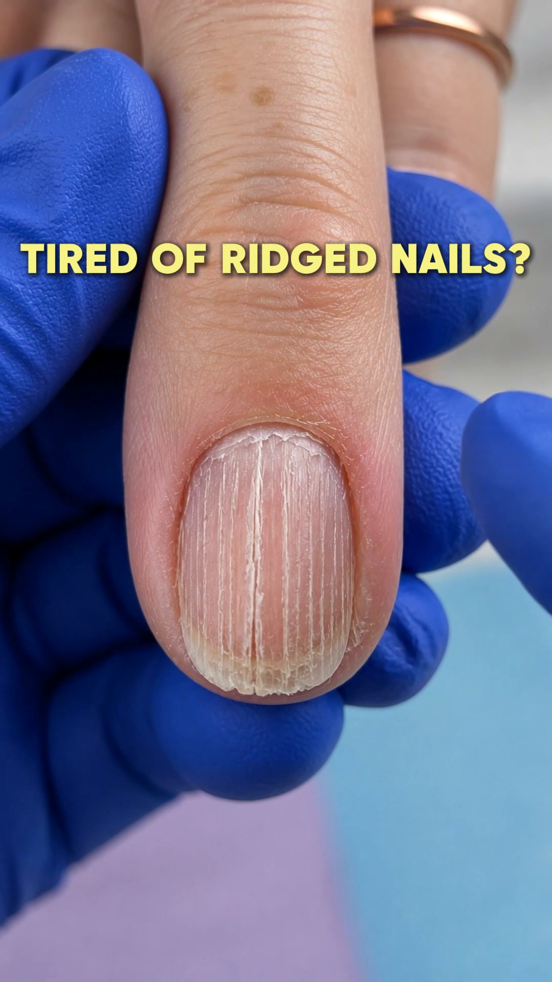 Why Nails Get Ridges After 50