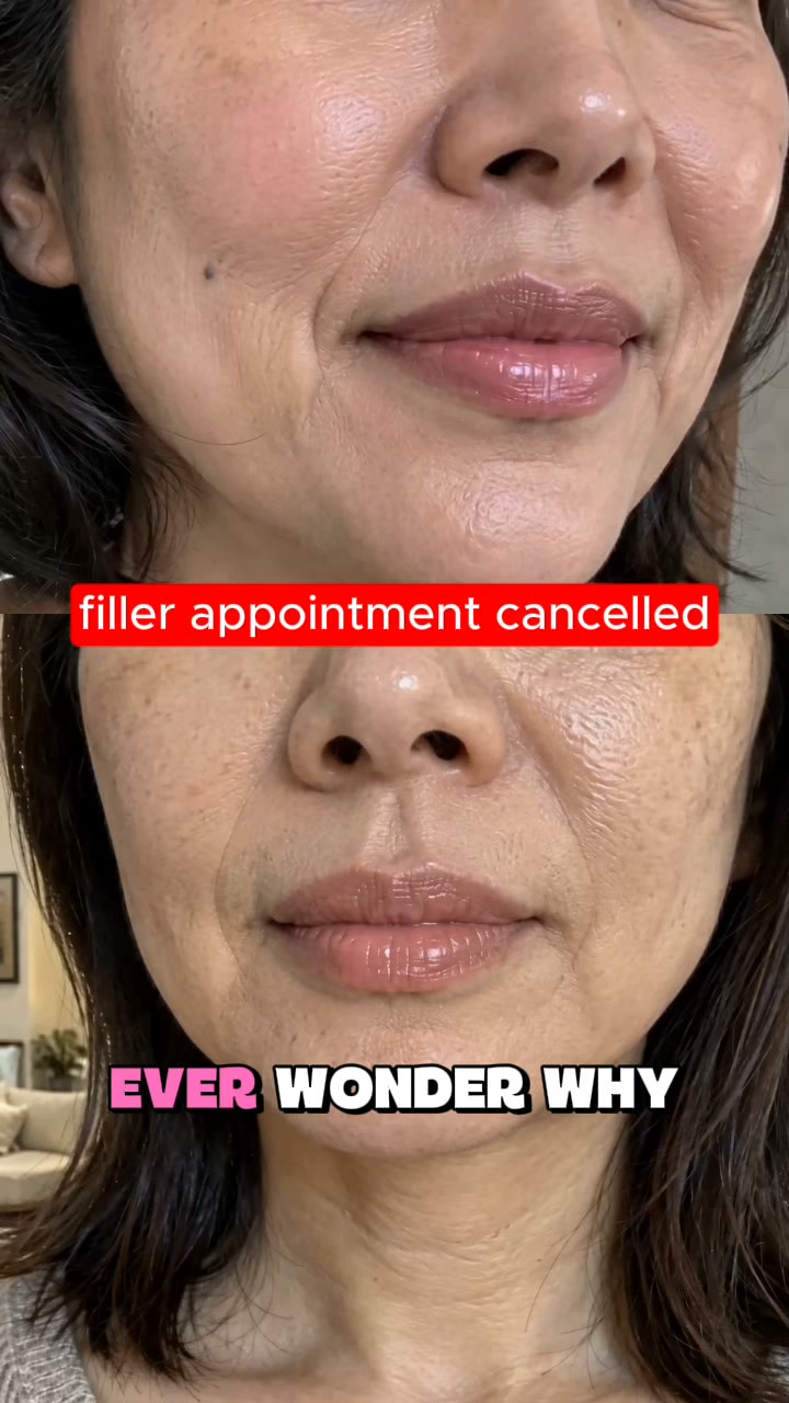Before You Book Filler, Try Lipvia