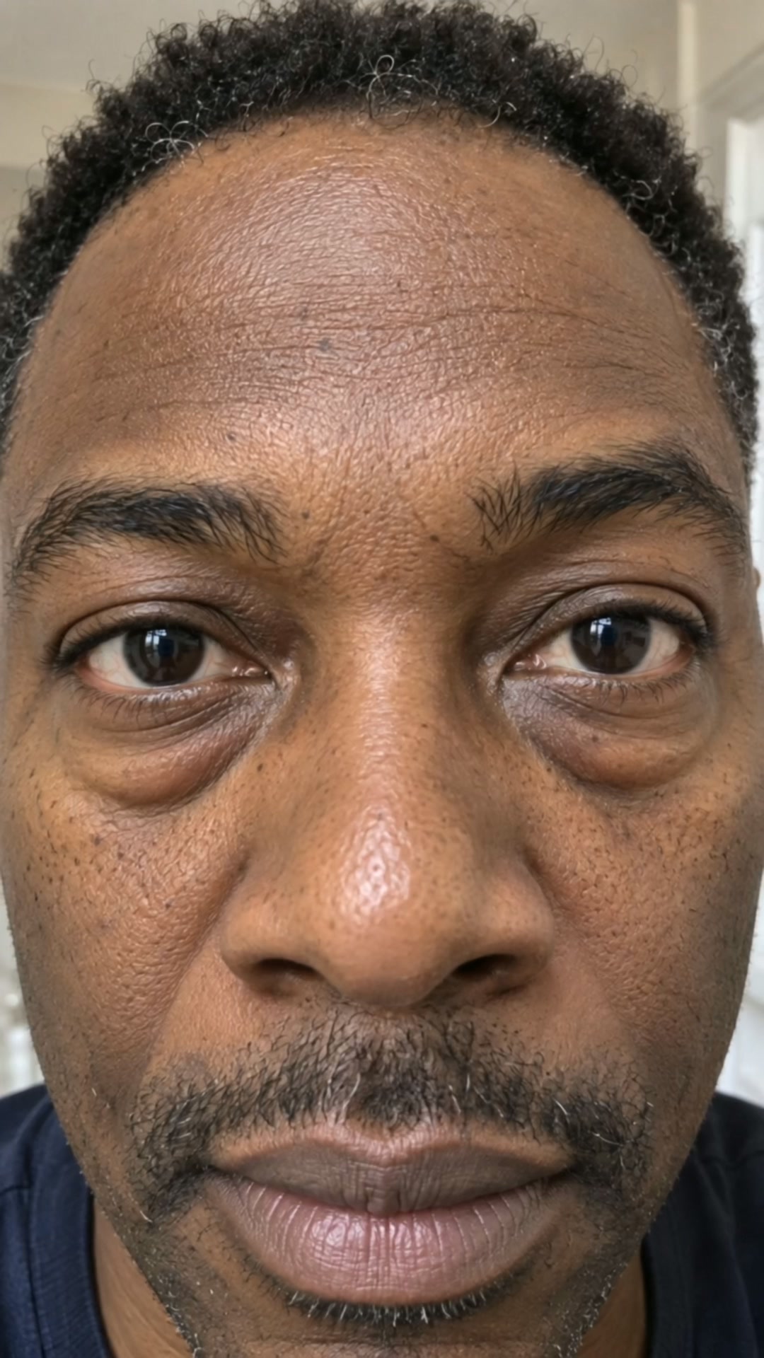 Black men's eye bags. Real solution.