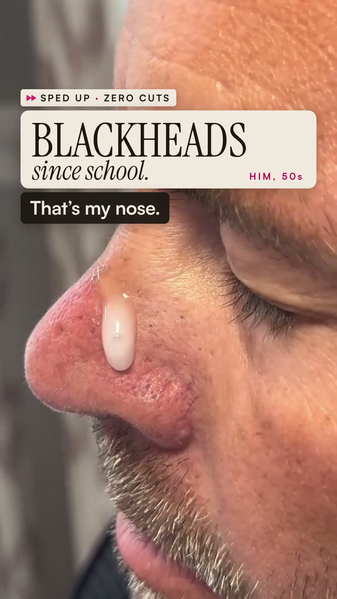 Say goodbye to blackheads