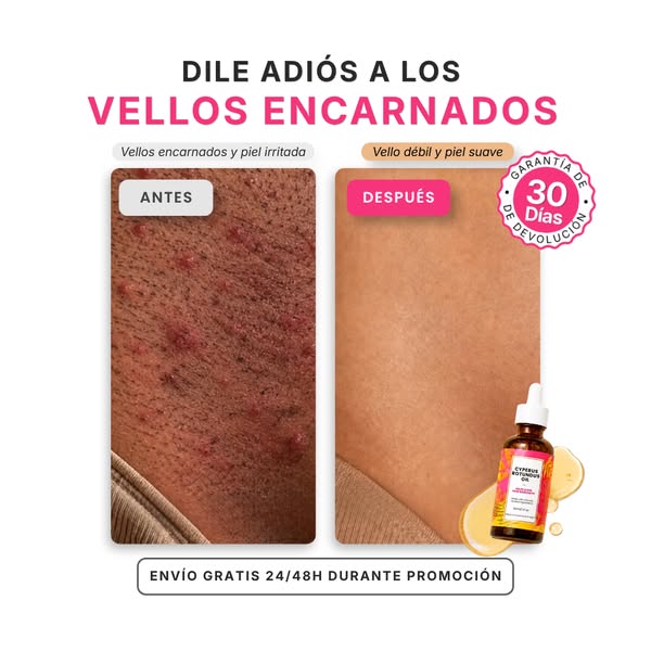 Adióѕ a la foliculitis y vellos encarnados
