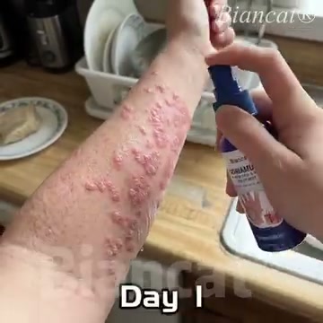 Tired of Itching, Flaking & Greasy Creams?