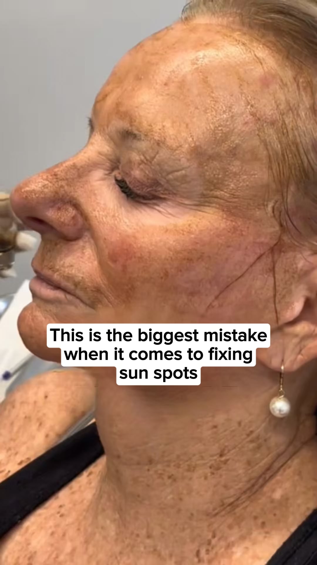 Let's talk about Age Spots.