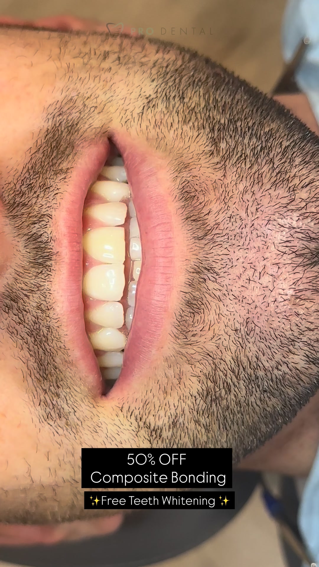 Up to 50% Composite Bonding and Veneers