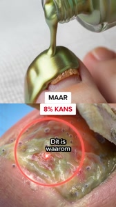 De fout die bijna iedereen met een kalknagel maakt
