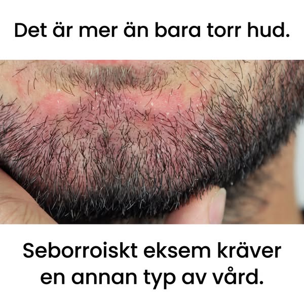 Lindra Klåda, Minska Fjällning, Må Bättre