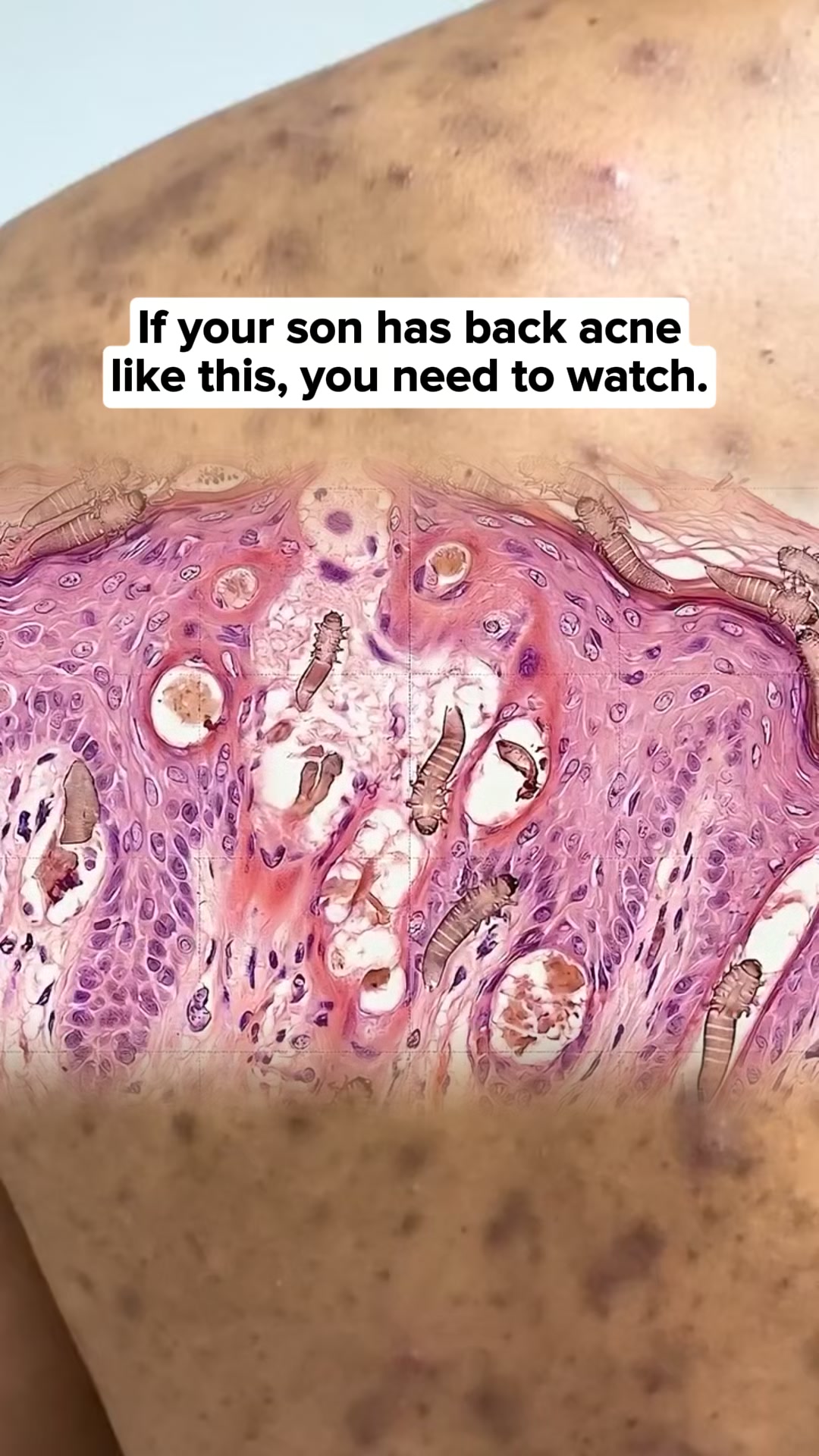Goodbye Back Acne!