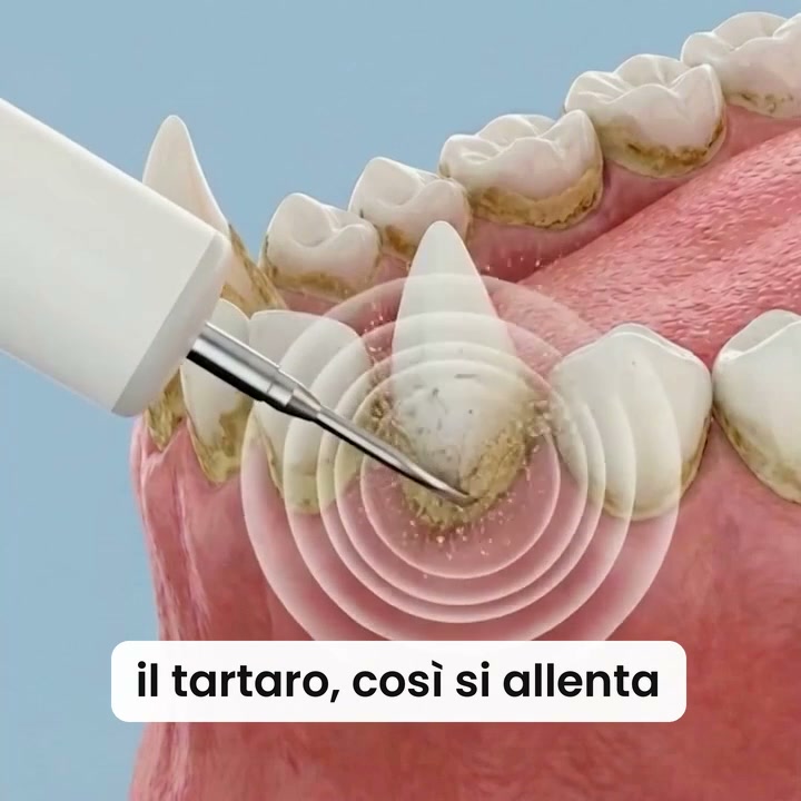 Rimuovi il tartaro — Comodea Dental
