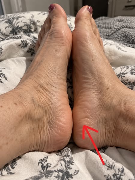 Read this if you are a woman over 45 with plantar fasciitis and cannot get orthotics, supportive shoes, or physio to make any lasting differ
