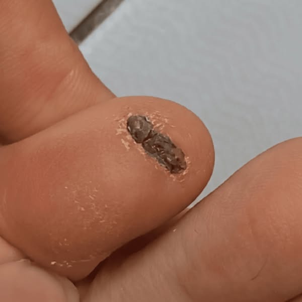 A mycologist told me why nothing works for toenail fungus