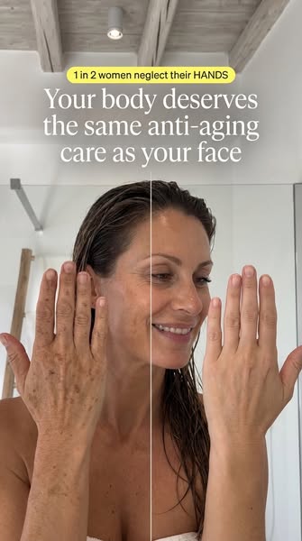 Why Sun Spots Hit the Hands First