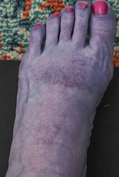 How I discovered my 'permanent' nerve damage wasn't permanent…