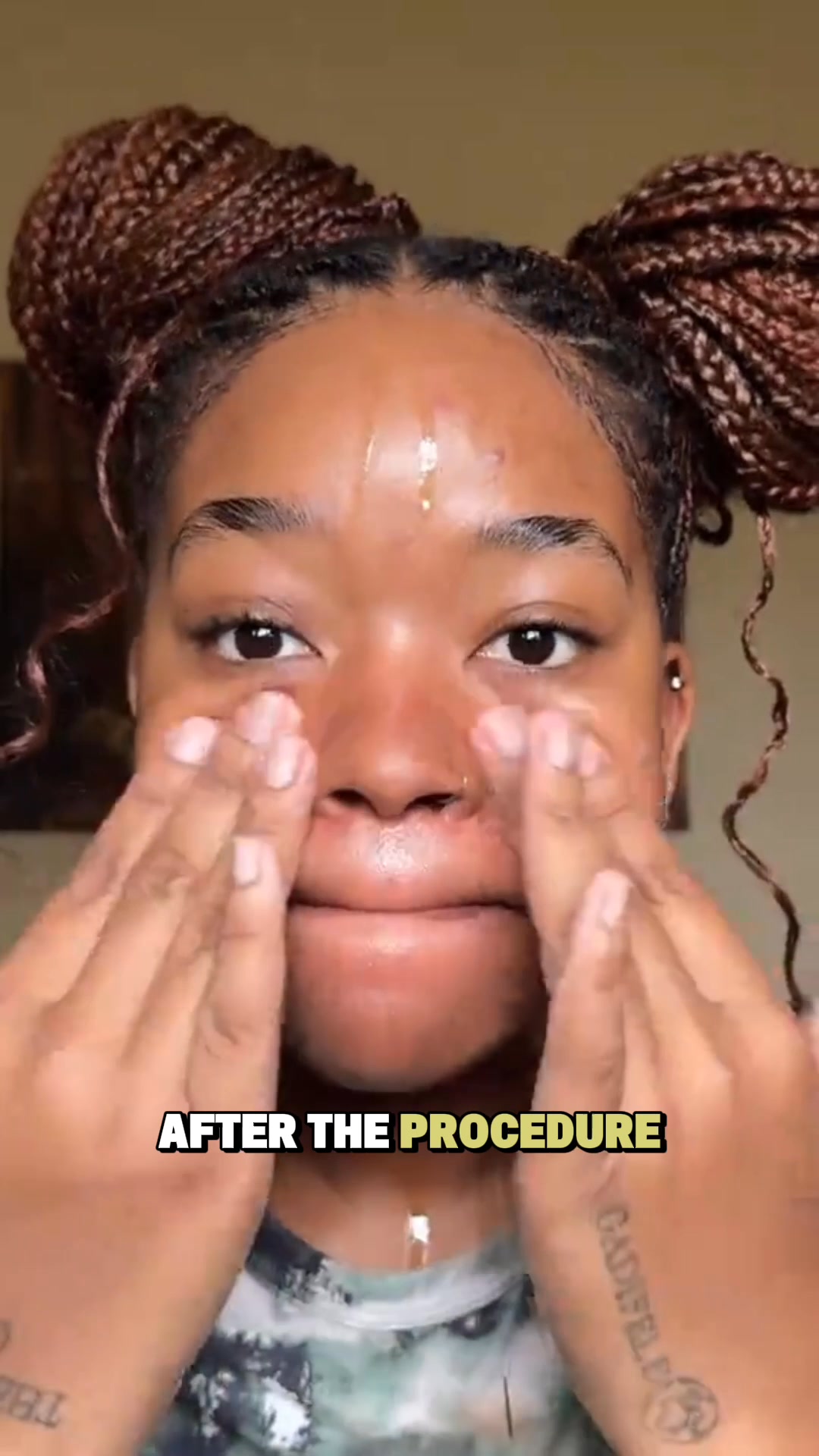 Anúncio de Banish Acne Scars
