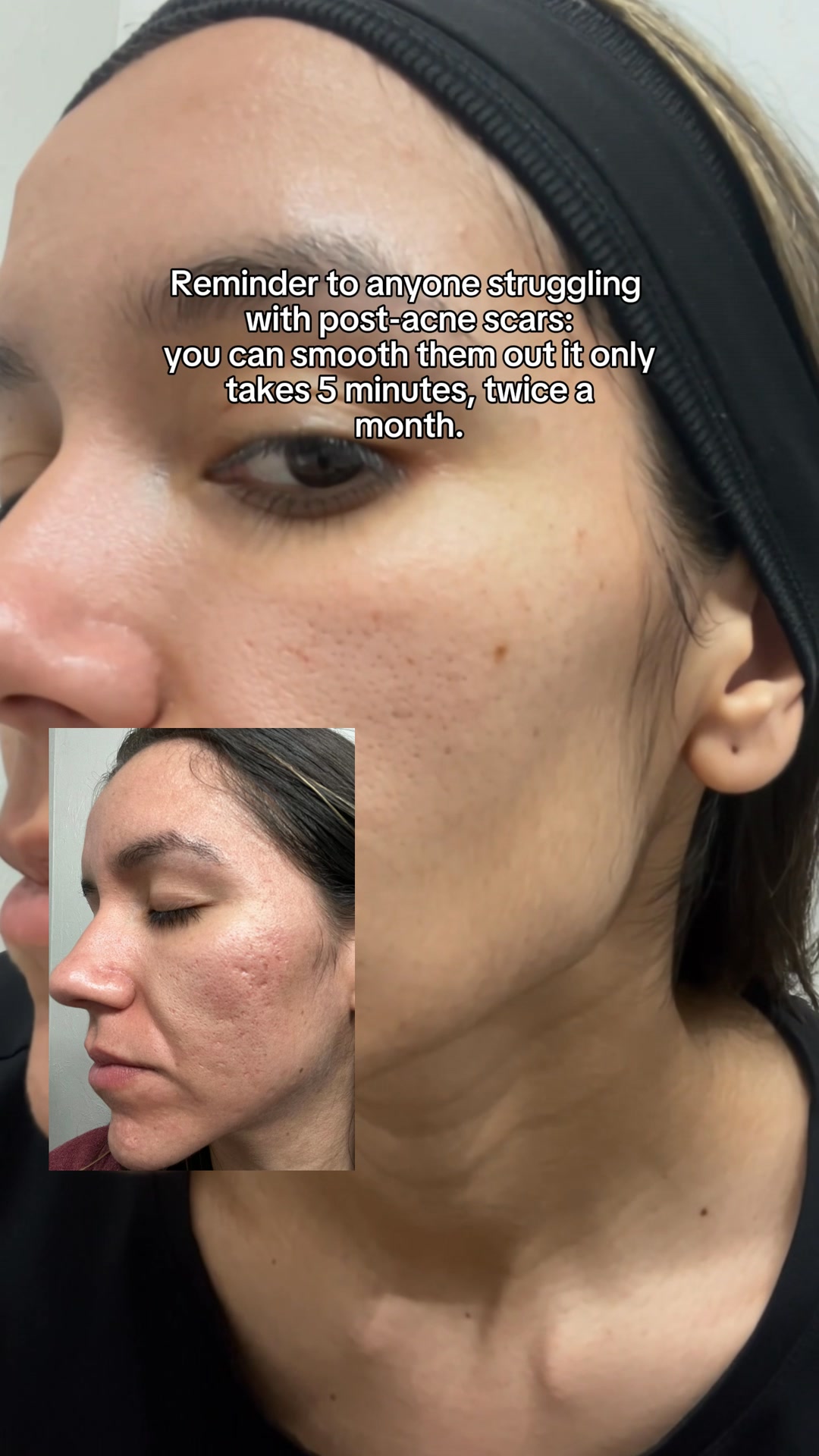The DNA Repair Hack for Acne Scars