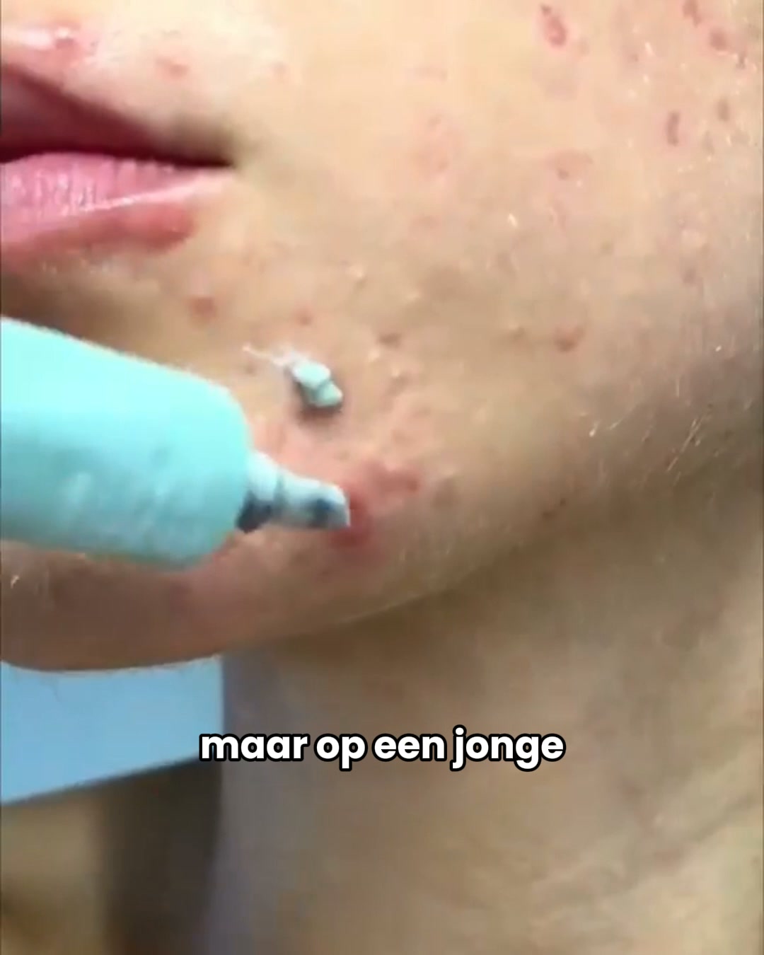 Stop Acne - Bespaar 50%