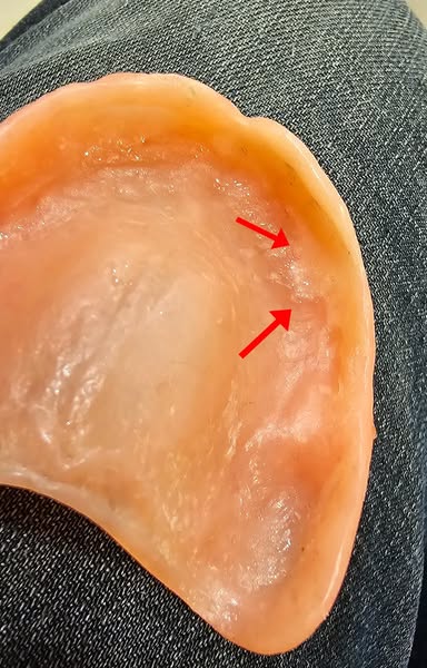 Read this if you wear dentures and use cream.