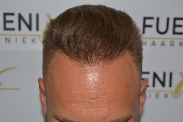 FueGenix | Exclusive Hair Transplant