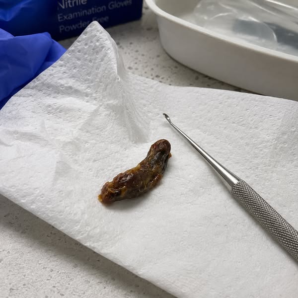 The only ear wax remover i would recommend.