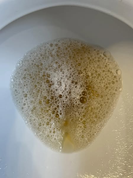 Cholesterol Is Damaging Your Kidneys